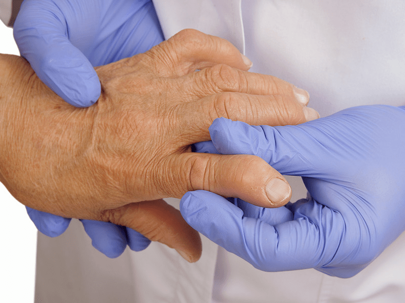 médico examina a mão em busca de dor nas articulações dos dedos