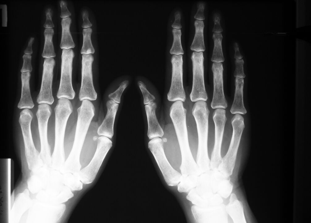 raio-x para diagnosticar dor nas articulações dos dedos
