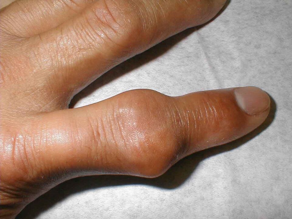 tofos na articulação do dedo como causa de dor