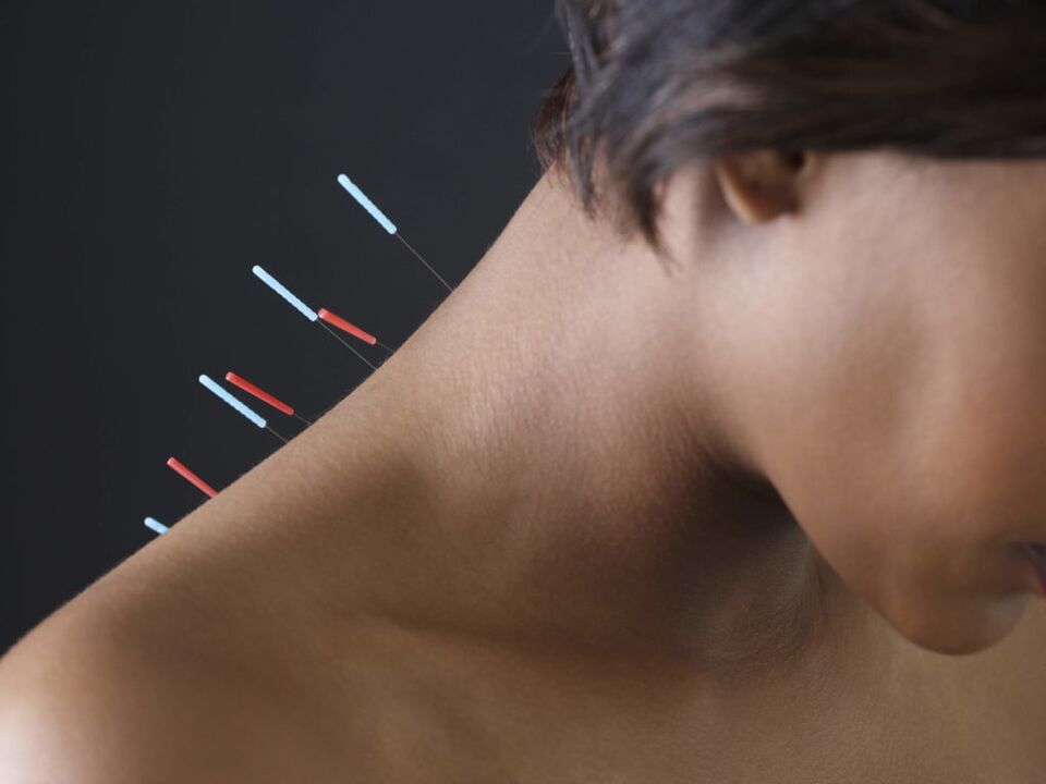 Acupuntura para osteocondrose cervical elimina processos inflamatórios